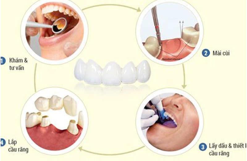 quy trình bọc răng sứ
