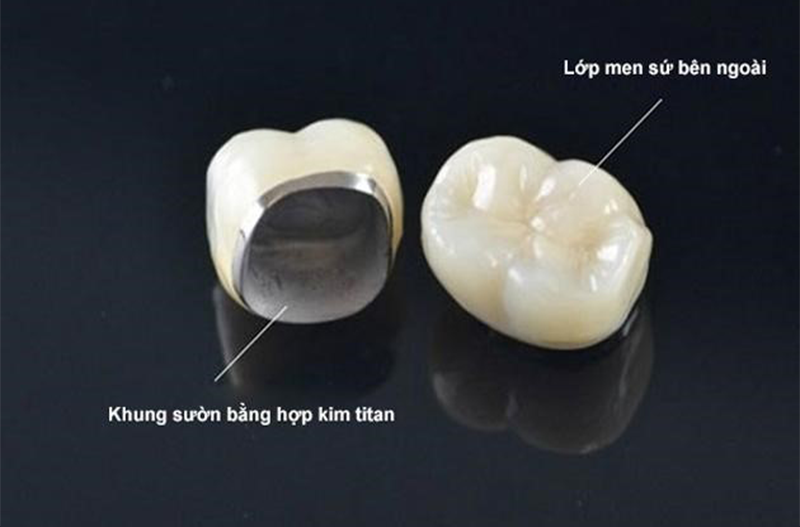 răng sứ titan