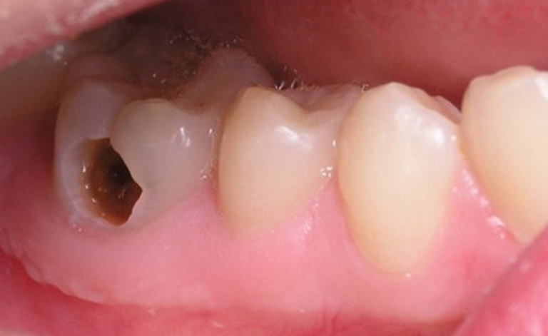 Trám Răng Inplay là gì? Tổng Hợp Phương Pháp Điều Trị Sâu Răng Tốt Nhất