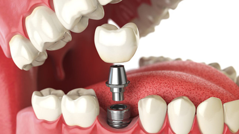 Trồng Răng Implant Có Đau Không? Tại Sao Nên Thực Hiện Phương Pháp Trồng Răng Implant?