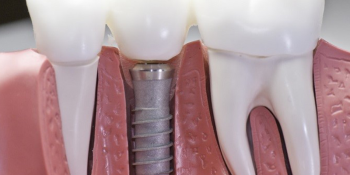 Trồng Răng Implant Giá Bao Nhiêu?