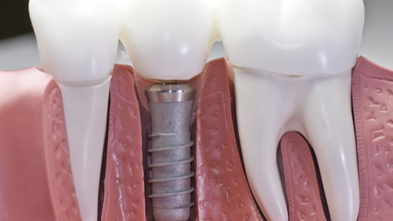 Trồng Răng Implant Giá Bao Nhiêu?