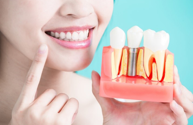 trồng răng implant giá bao nhiêu