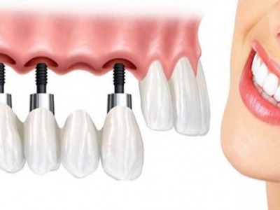 Trồng Răng Implant Mất Bao Lâu?