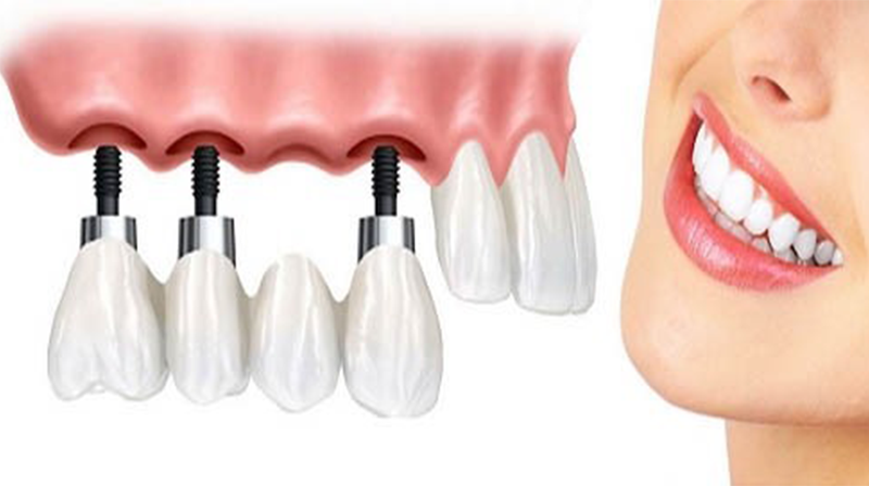 Trồng răng Implant mất bao lâu?