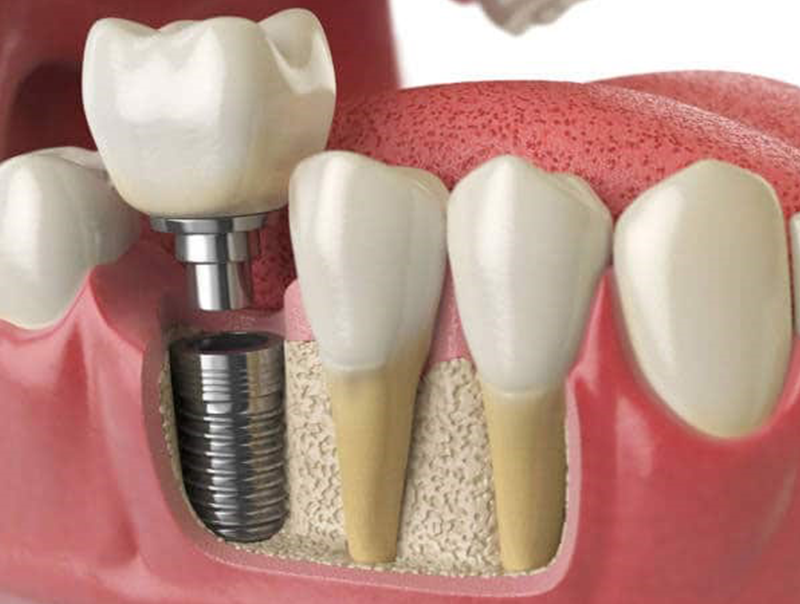 trồng răng implant ở đâu tốt tphcm