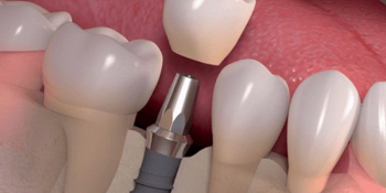 Trồng Răng Implant Ở Đâu Tốt TPHCM
