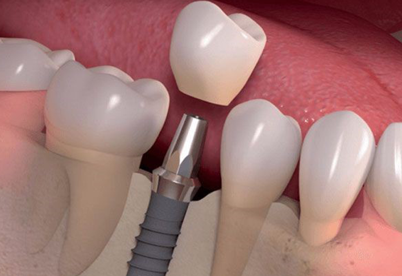 trồng răng implant ở đâu tốt tphcm
